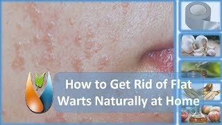 How to Cure Flat Warts Naturally at Home [upl. by Anerb]