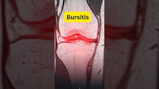 What is Bursitis drmuhammedziya humanbody discover anatomy bursitis knee shoulder [upl. by Joline]