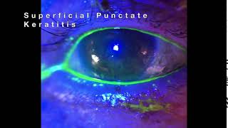 Superficial Punctate Keratitis SPK [upl. by Nylarahs]