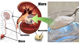 Ein Teelöffel davon pro Tag kann deine beschädigte Niere natürlich ohne Medikamente reparieren [upl. by Deborath]