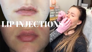 Getting lip injections Botox at 17 My Experience [upl. by Nutsud]