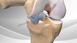 All Inside ACL Reconstruction with Arthrex® GraftLink® [upl. by Yrrol107]