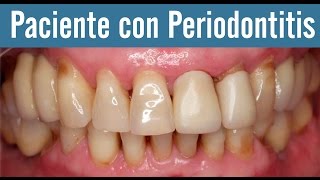 Implantes dentales EL PACIENTE CON PERIODONTITIS  Juan Salgado  Odontologia [upl. by Ida]