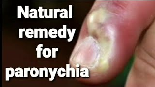 How to Get Rid of a Paronychia [upl. by Boleslaw680]