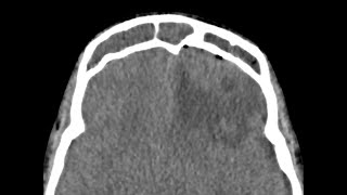 Intracranial abscess  complicated sinusitis [upl. by Batruk]