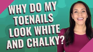 Why do my toenails look white and chalky [upl. by Androw647]