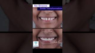 No Braces Teeth Gaps Closure In One Visit  By DrPraneeth [upl. by Paulita]