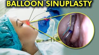 The Balloon Sinuplasty Breakthrough A Painless Path to Clear Sinuses 3d animation [upl. by Ogg]