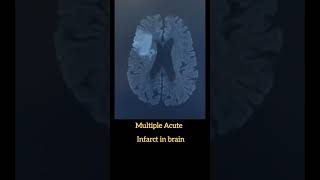 Multiple Acute infarct in Brain [upl. by Massingill]