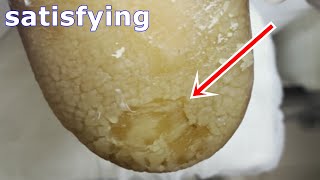 Cracked heels treatment amp Callus removal  Dead skin removal and Cracked heels treatment part 2 [upl. by Einwahr939]