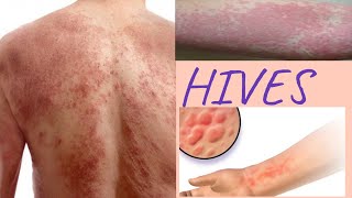 HIVES causes  Natural remedies to get rid of hive at home [upl. by Henryk]