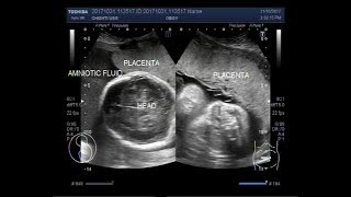 Ultrasound Video showing Polyhydramnios and other fetal anomalies [upl. by Euqilegna214]