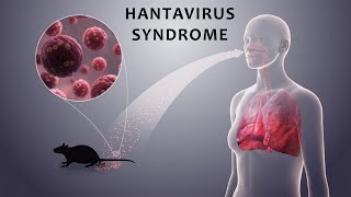 Hantavirus Syndrome [upl. by Colene]