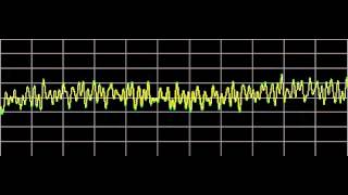 Rheumatoid Arthritis  Rife Frequencies [upl. by Oicul503]