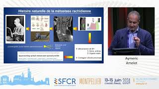 TABLE RONDE  Chirurgie et traitement des métastases vertébrales [upl. by Gorski]