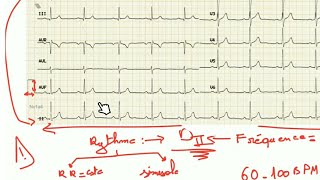 ECG  trouble du rythme et fréquence prt 1 [upl. by Aronas]