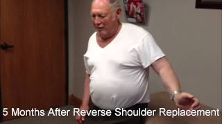 Before and After Reverse Shoulder Replacement [upl. by Chui89]