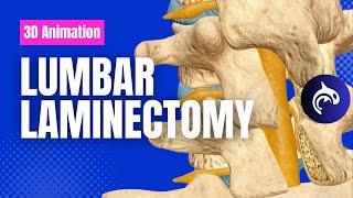 Lumbar Laminectomy  3D Animation [upl. by Micheal]