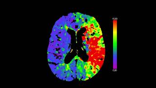 Herseninfarct acute behandelingen [upl. by Caia]