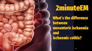 Whats the difference between mesenteric ischaemia and ischaemic colitis [upl. by Aeriel]