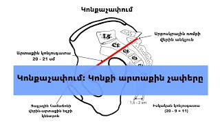 Կոնքաչափում Կոնքի արտաքին չափերը [upl. by Leatri866]