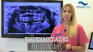 ¿Qué son las enfermedades periodontales [upl. by Esidarap499]