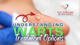 Understanding Warts and Treatment Options [upl. by Alegnaed273]