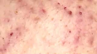 Acne Treatment 2023  Pimples Removal EP306 acne blackhdeads skincare [upl. by Atiuqnahs]