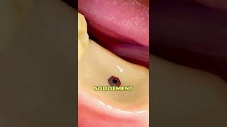 Comment fonctionne les implants dentaires 🤔🦷 [upl. by Atteiram]