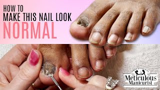 How to make a Thick Toenail with Fungus look Normal [upl. by Fishbein]