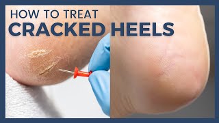 How To Treat Cracked Heels  Reduce Callus and Fissures [upl. by Ayhdiv448]