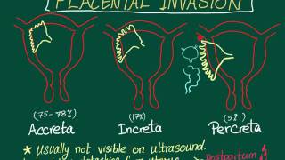 Placental Invasion Placenta Accreta Increta and Percreta mnemonic [upl. by Galitea]