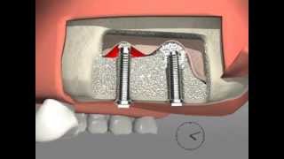 Smart Lift  Kit for Maxillary Sinus Lift with Crestal Approach [upl. by Vally30]