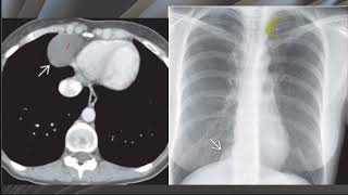 Webinar short talks  001 Differential Diagnosis of Cardiophrenic Space Lesions [upl. by Trub]