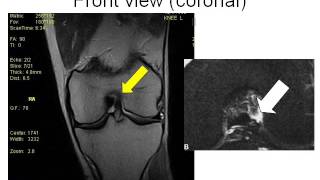 How to Read Knee MRI of ACL Tear  Torn ACL  Santa Fe Knee Specialist [upl. by Penelopa]