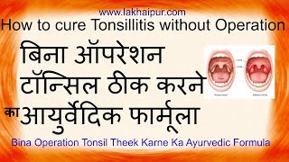 How to cure tonsils naturally  Tonsils ka gharelu elaaj  टॉन्सिल ठीक करने आयुर्वेदिक फार्मूला [upl. by Richard]