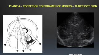 TMT Neurosono by Dr Mrudula Bapat  Basic Anatomy amp Scanning Technique [upl. by Yrod]