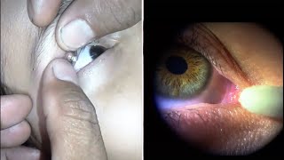 EYE string removal ASMR 소름 쫙실눈곱 제거 오돌토돌 비립종 압출 애니메이션 [upl. by Burg754]