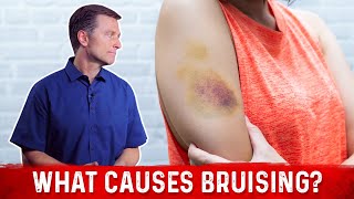 What Causes Bruising Without Trauma – Dr Berg [upl. by Isiad]