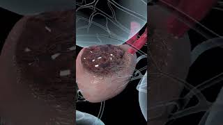 Prostate Cancer Explained Animation [upl. by Emirac]