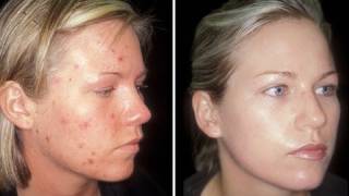 HOW TO CURE ACNE  CLEAR SKIN IN ONE WEEK [upl. by Nile]