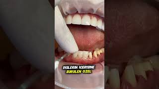 Diş Kaplamaları Nasıl Yapıştırılır dental dentist diş satisfying dentalclinic [upl. by Fadden]