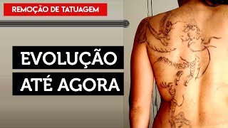 EVOLUÇÃO até a OITAVA SESSÃO  Remoção de Tatuagem 081 [upl. by Hernando]