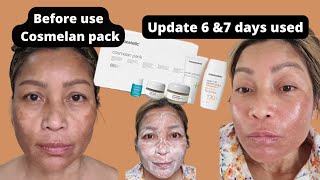 Update Day 6 amp 7 used Cosmelan pack my melasma getting better [upl. by Uahc]