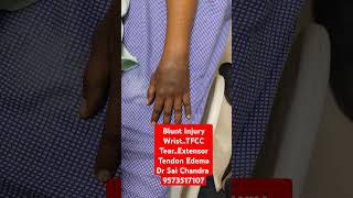 Blunt Injury WristTFCC TearExtensor Tendon Edema Dr Sai Chandra 9573517107 [upl. by Cirtemed]