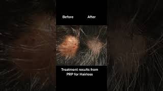 Prp hair treatment prp prphair prphairtreatment prphairrestoration prptherapy [upl. by Daph]