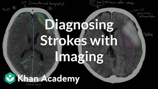 Diagnosing strokes with imaging CT MRI and Angiography  NCLEXRN  Khan Academy [upl. by Dagna]