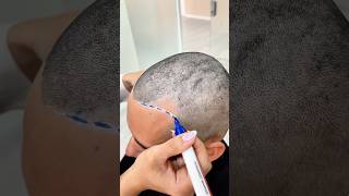 Restoring the hairline and filling temples for early stage hair loss vincihairclinic shorts [upl. by Candie280]