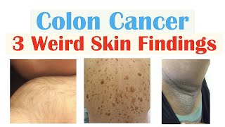 3 Weird Signs of Colon Cancer Found on the Skin [upl. by Golliner]