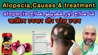 Alopecia causes and treatments optionsUrduHindi [upl. by Ellened453]